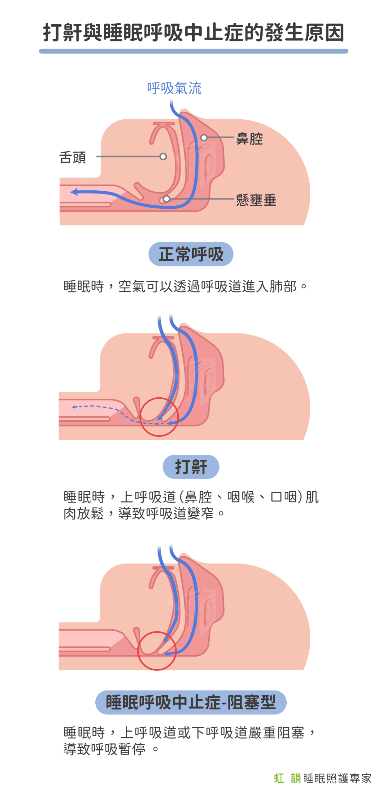 打鼾與睡眠呼吸中止發生的原因
